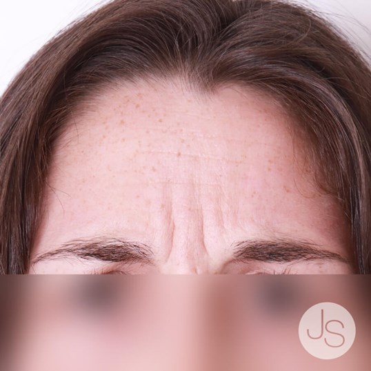 Botox Before and After Pictures Beverly Hills, CA