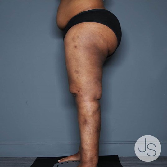 Lipedema Before and After Pictures Beverly Hills, CA