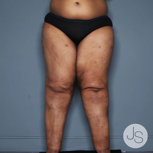 Lipedema Before and After Pictures Beverly Hills, CA