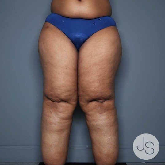 Lipedema Before and After Pictures Beverly Hills, CA