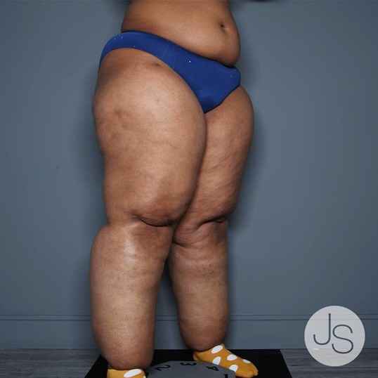 Lipedema Before and After Pictures Beverly Hills, CA