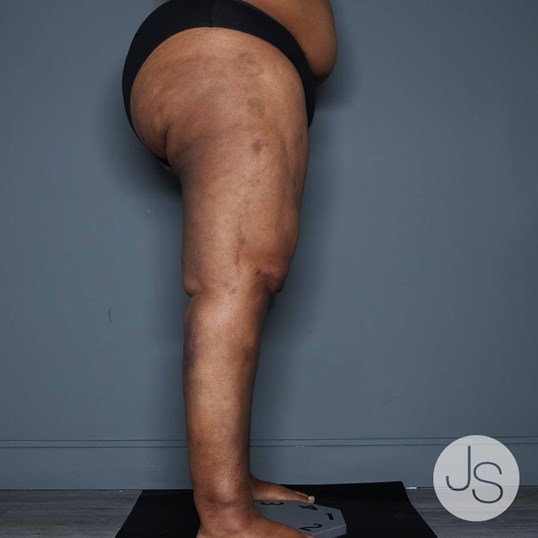 Lipedema Before and After Pictures Beverly Hills, CA