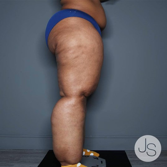Lipedema Before and After Pictures Beverly Hills, CA