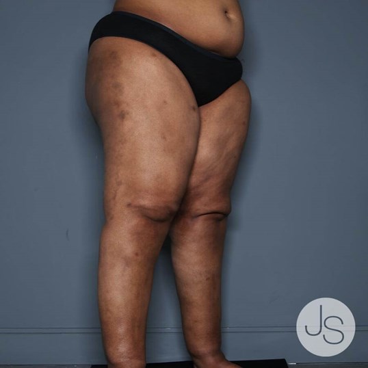 Lipedema Before and After Pictures Beverly Hills, CA