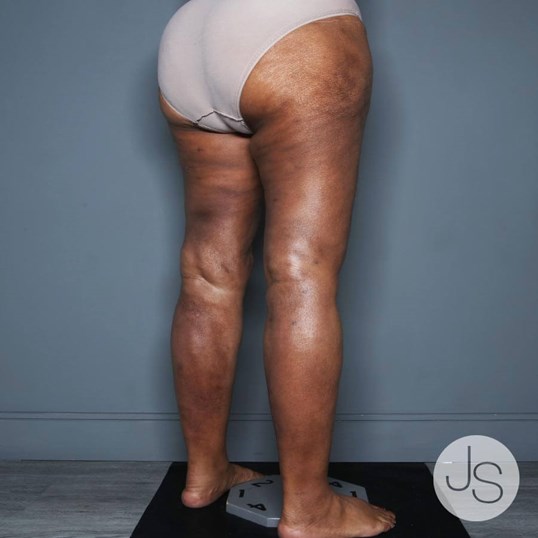 Lipedema Before and After Pictures Beverly Hills, CA