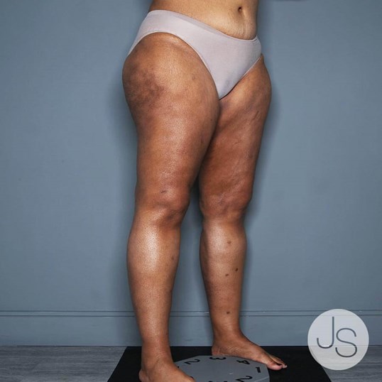 Lipedema Before and After Pictures Beverly Hills, CA