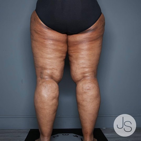 Lipedema Before and After Pictures Beverly Hills, CA