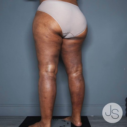 Lipedema Before and After Pictures Beverly Hills, CA