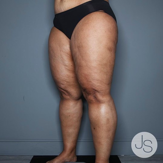 Lipedema Before and After Pictures Beverly Hills, CA