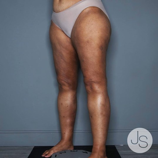 Lipedema Before and After Pictures Beverly Hills, CA