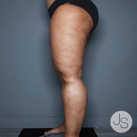 Lipedema Before and After Pictures Beverly Hills, CA