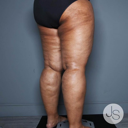 Lipedema Before and After Pictures Beverly Hills, CA