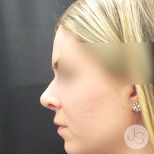 Nonsurgical Rhinoplasty Before and After Pictures Beverly Hills, CA