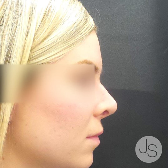 Nonsurgical Rhinoplasty Before and After Pictures Beverly Hills, CA