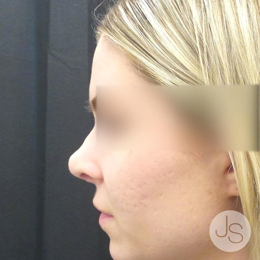Nonsurgical Rhinoplasty Before and After Pictures Beverly Hills, CA