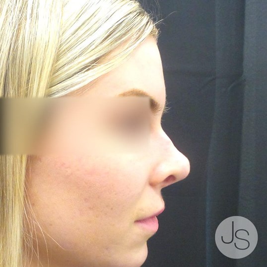 Nonsurgical Rhinoplasty Before and After Pictures Beverly Hills, CA