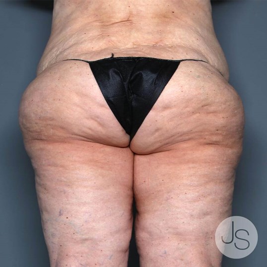 Lipedema Before and After Pictures Beverly Hills, CA