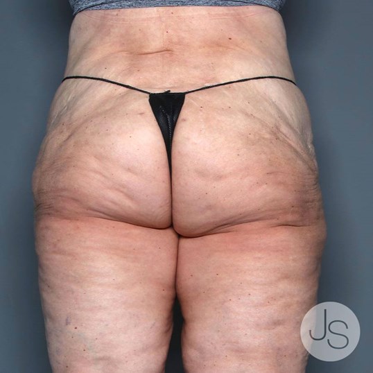 Lipedema Before and After Pictures Beverly Hills, CA