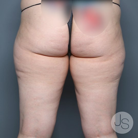 Lipedema Before and After Pictures Beverly Hills, CA