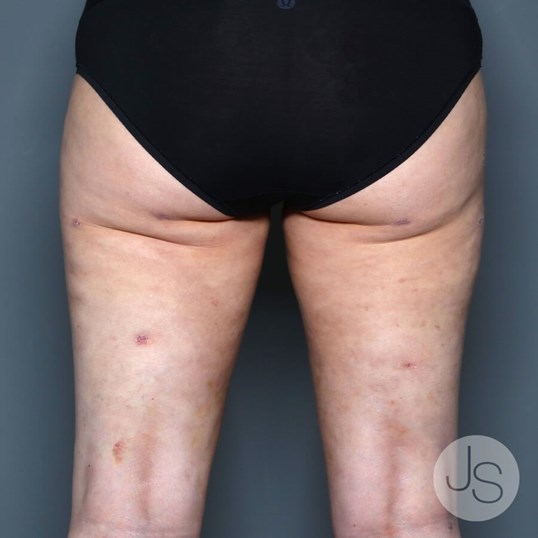 Lipedema Before and After Pictures Beverly Hills, CA