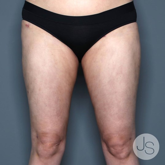 Lipedema Before and After Pictures Beverly Hills, CA