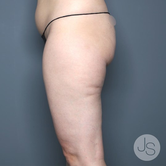 Lipedema Before and After Pictures Beverly Hills, CA