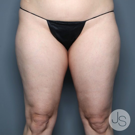 Lipedema Before and After Pictures Beverly Hills, CA