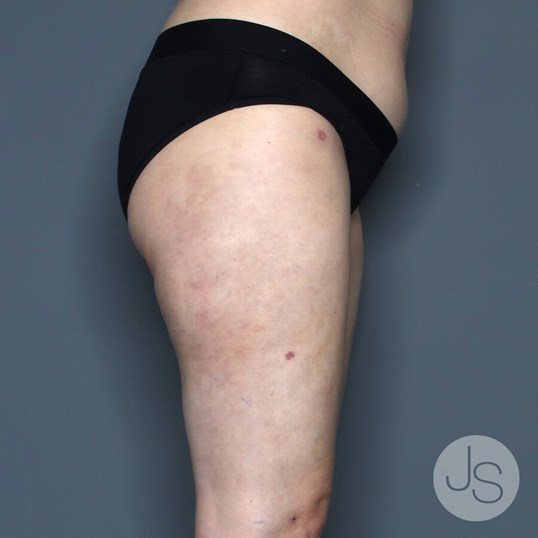 Lipedema Before and After Pictures Beverly Hills, CA