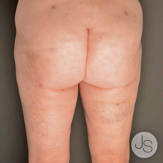 Cellulite Reduction Before and After Pictures Beverly Hills, CA