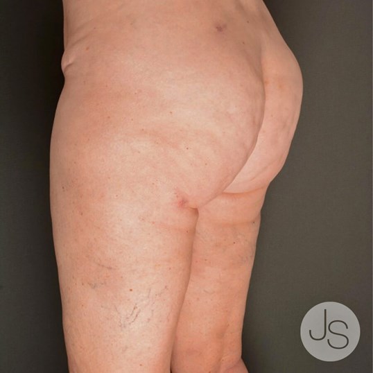 Cellulite Reduction Before and After Pictures Beverly Hills, CA