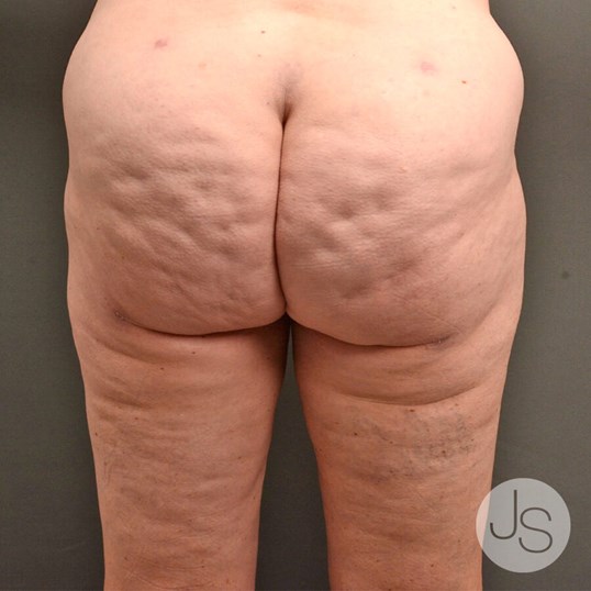 Cellulite Reduction Before and After Pictures Beverly Hills, CA