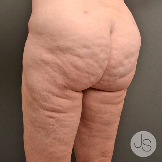 Cellulite Reduction Before and After Pictures Beverly Hills, CA