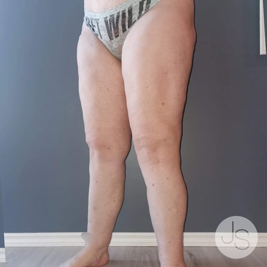 Lipedema Before and After Pictures Beverly Hills, CA