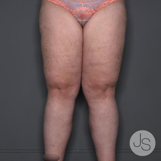 Lipedema Before and After Pictures Beverly Hills, CA