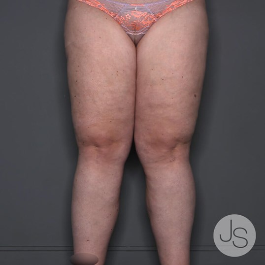 Lipedema Before and After Pictures Beverly Hills, CA