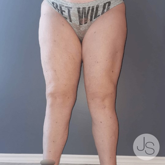 Lipedema Before and After Pictures Beverly Hills, CA