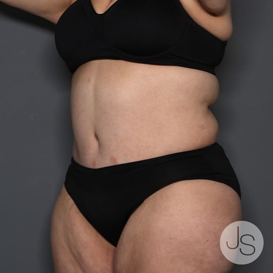 Lipedema Before and After Pictures Beverly Hills, CA