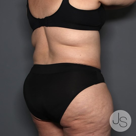 Lipedema Before and After Pictures Beverly Hills, CA