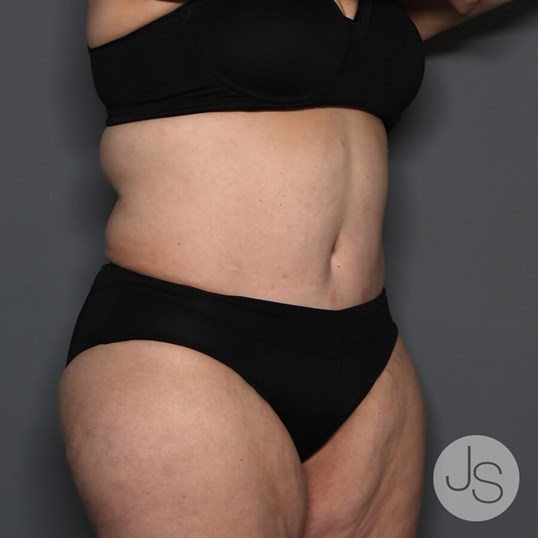 Lipedema Before and After Pictures Beverly Hills, CA