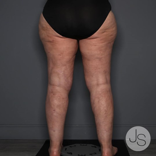 Lipedema Before and After Pictures Beverly Hills, CA