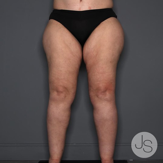 Patient #10350 Body Contouring Before and After Photos Beverly