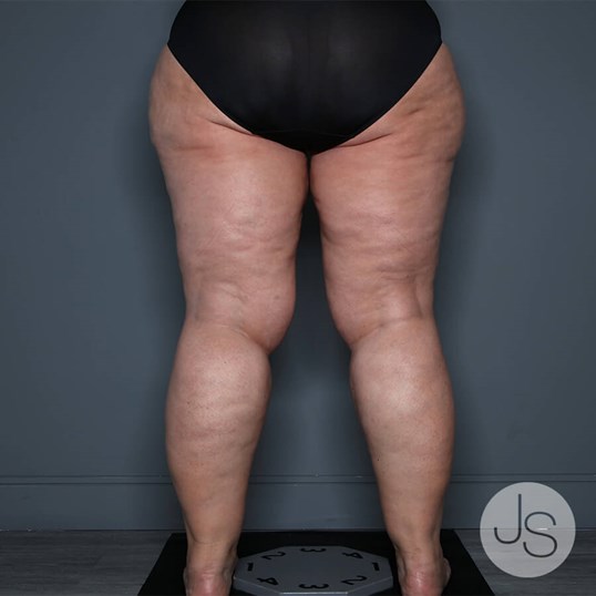 Lipedema Before and After Pictures Beverly Hills, CA