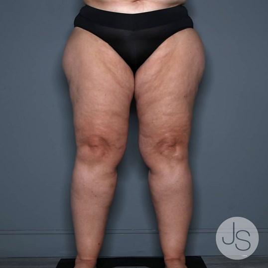 Lipedema Before and After Pictures Beverly Hills, CA