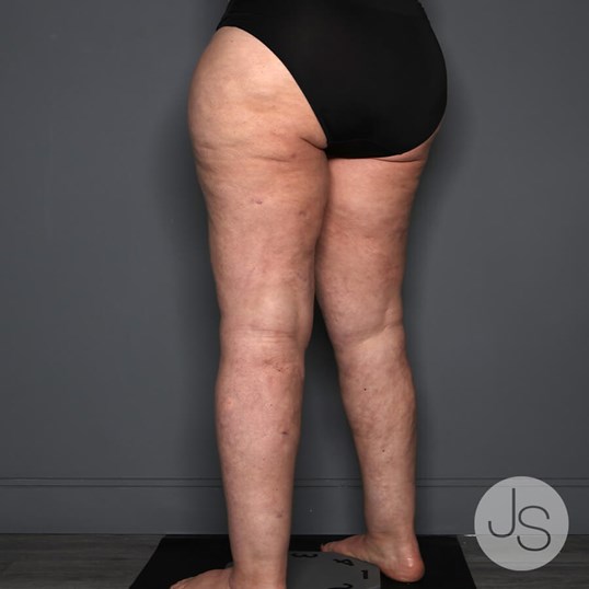 Lipedema Before and After Pictures Beverly Hills, CA