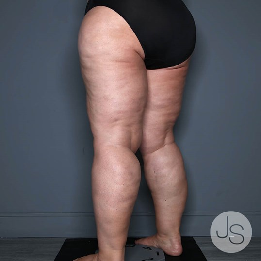 Lipedema Before and After Pictures Beverly Hills, CA