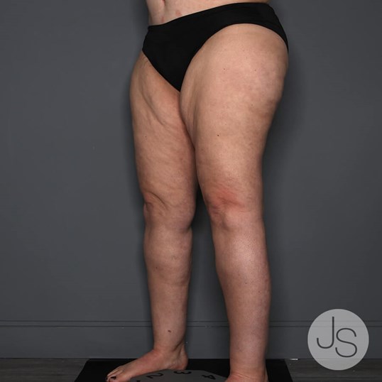 Lipedema Before and After Pictures Beverly Hills, CA