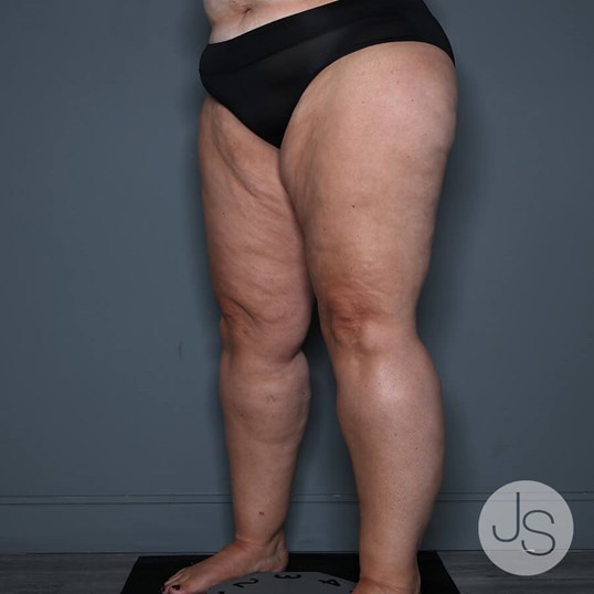 Lipedema Before and After Pictures Beverly Hills, CA