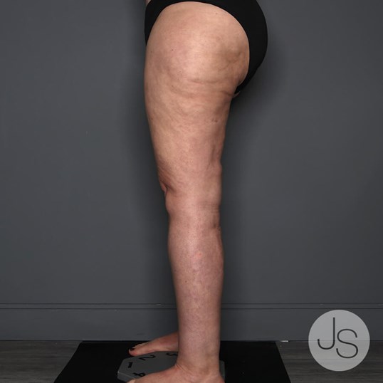 Lipedema Before and After Pictures Beverly Hills, CA