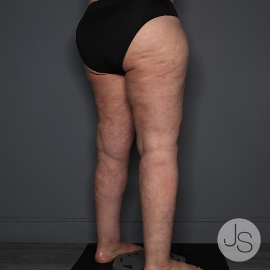 Lipedema Before and After Pictures Beverly Hills, CA