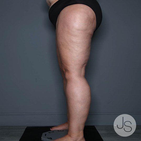 Lipedema Before and After Pictures Beverly Hills, CA